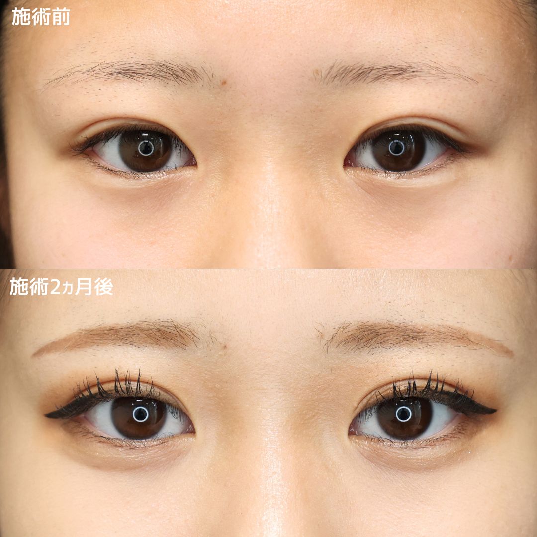 《二重埋没法》あと少し可愛くなりたい方へ