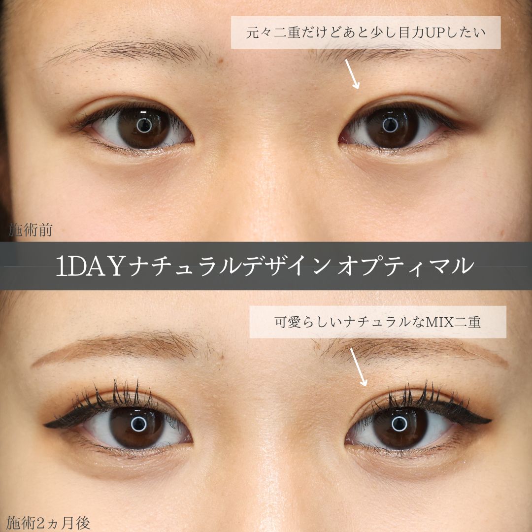 二重埋没法の症例写真 施術前後 