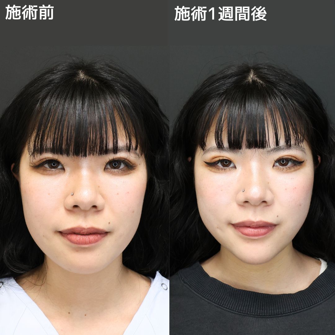 【小顔整形】ナチュラルだけど変化はしっかりと