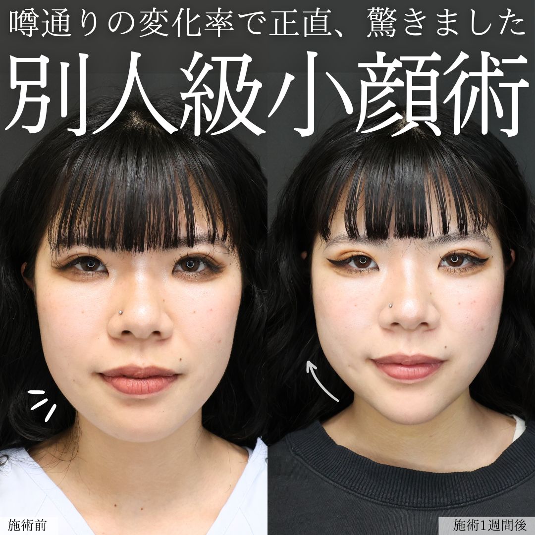 TAC式 ツヤ肌コラーゲンリフト®/Lラインファット除去（エラ下脂肪除去）/顔の脂肪吸引の症例写真 施術前後 