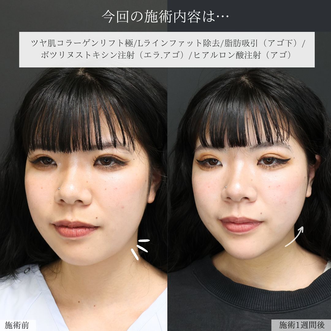 TAC式 ツヤ肌コラーゲンリフト®/Lラインファット除去（エラ下脂肪除去）/顔の脂肪吸引の症例写真 施術前後 