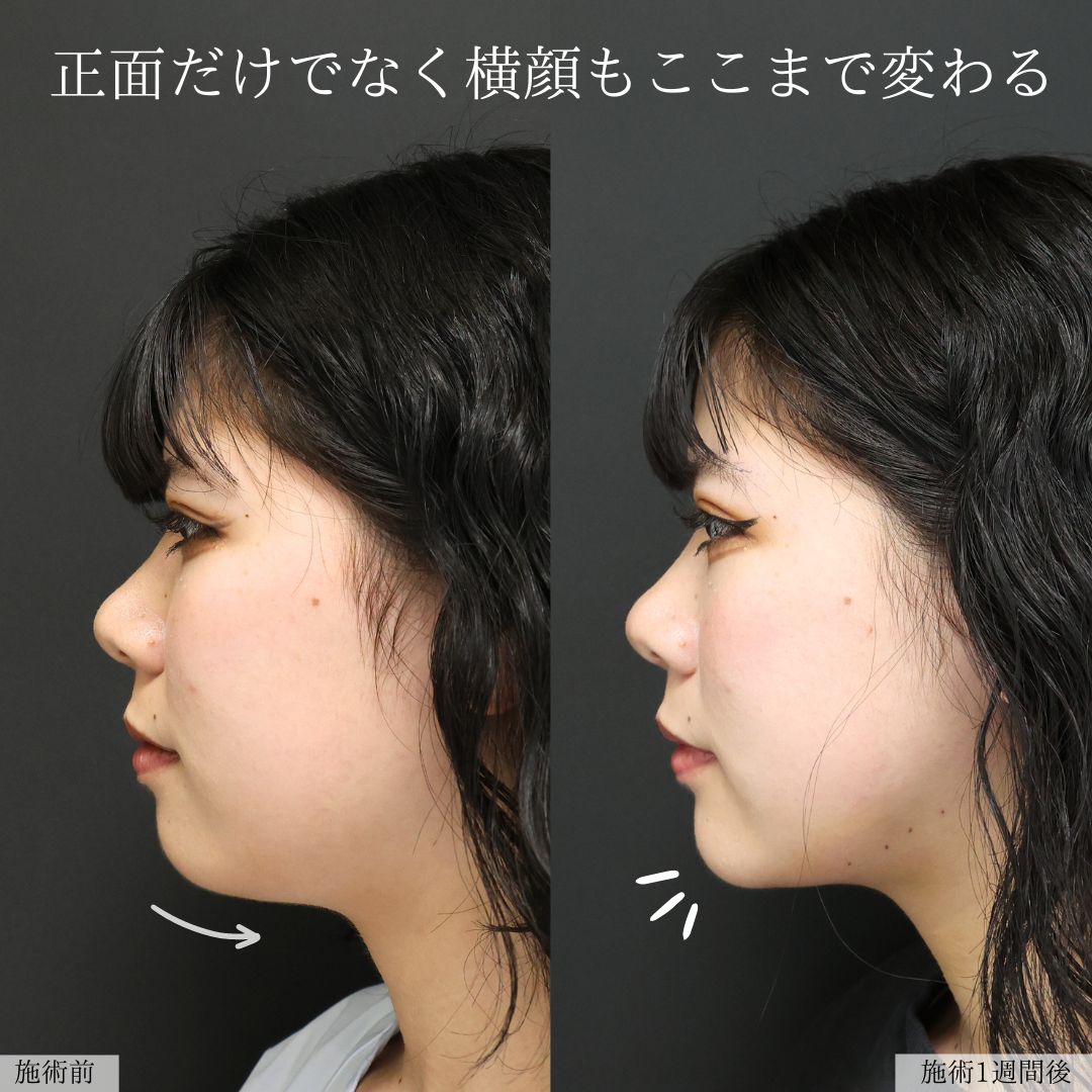 TAC式 ツヤ肌コラーゲンリフト®/Lラインファット除去（エラ下脂肪除去）/顔の脂肪吸引の症例写真 施術前後 