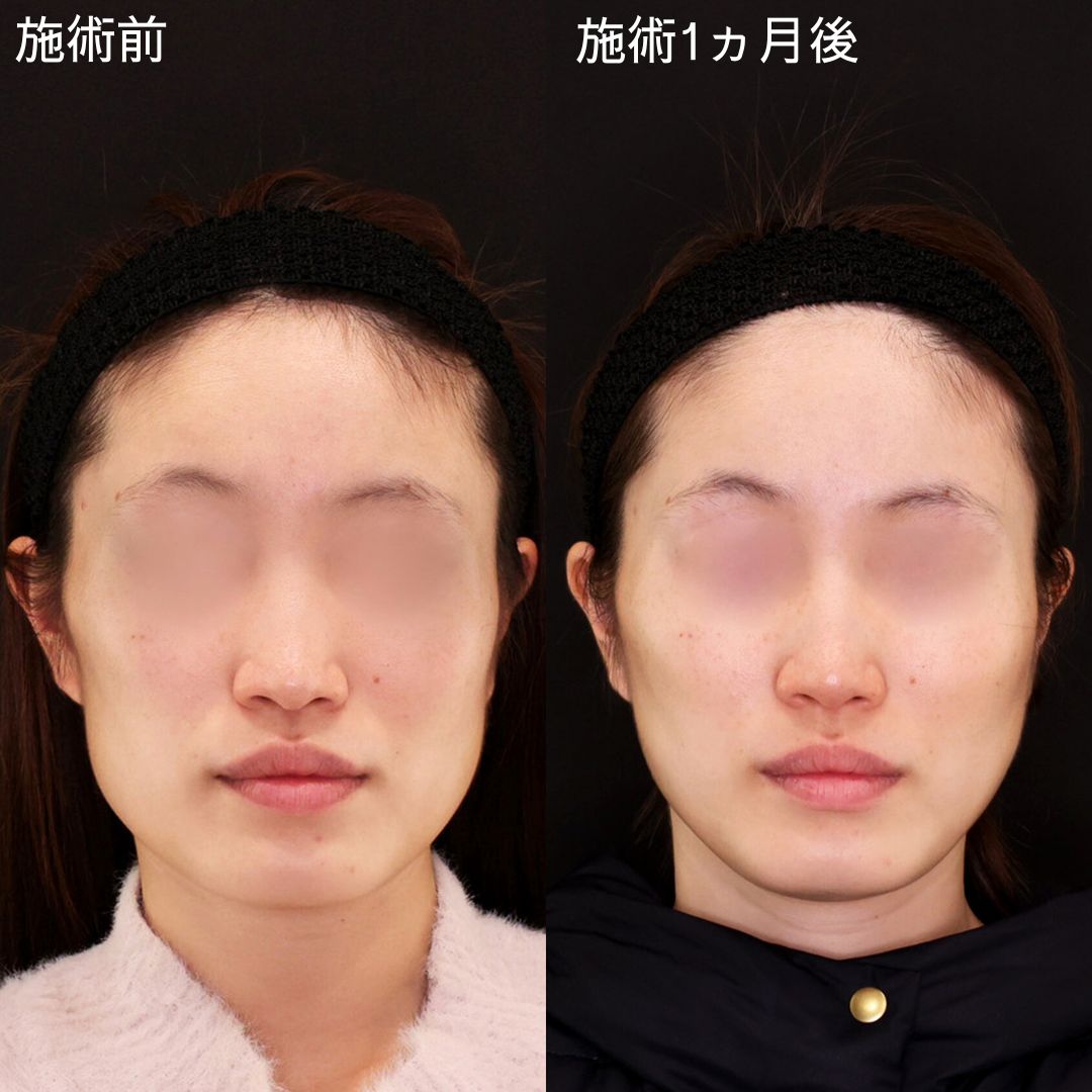 TAC式 ツヤ肌コラーゲンリフト®/エラボトックス注射の症例写真 施術前後