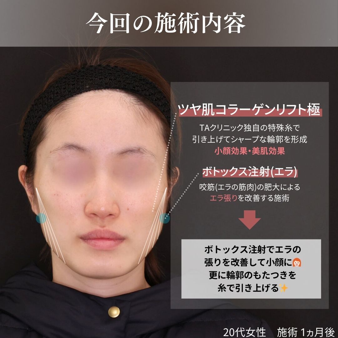 TAC式 ツヤ肌コラーゲンリフト®/エラボトックス注射の症例写真 施術前後