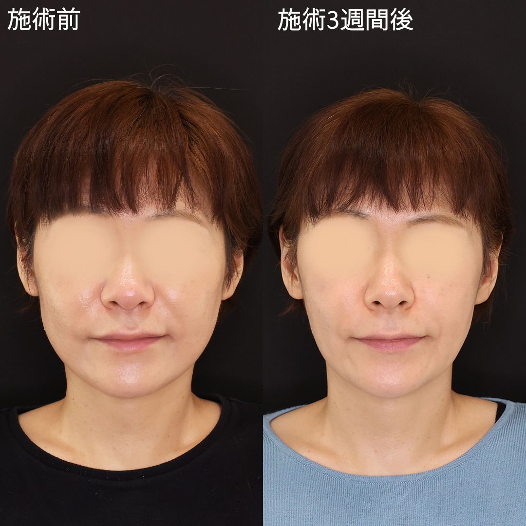 自然な変化で確実に垢抜ける！50代の若返り施術！【糸リフト】