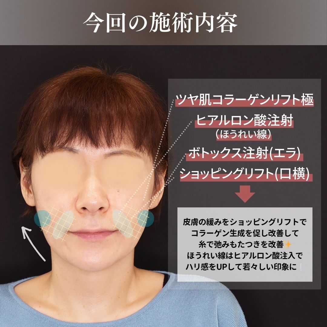 TAC式 ツヤ肌コラーゲンリフト®/ほうれい線のヒアルロン酸注射/エラボトックス注射の症例写真 施術前後 