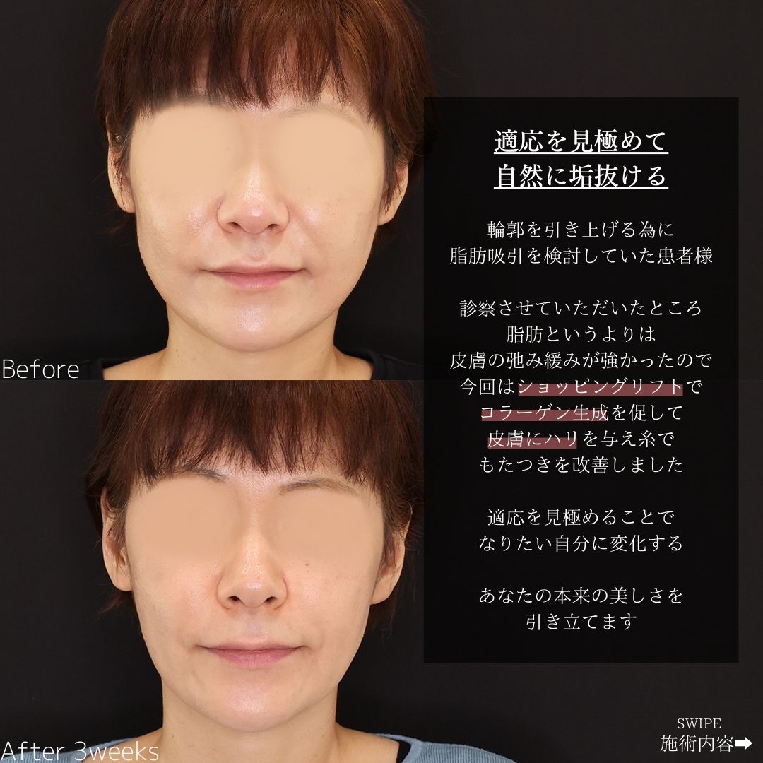 TAC式 ツヤ肌コラーゲンリフト®/ほうれい線のヒアルロン酸注射/エラボトックス注射の症例写真 施術前後 