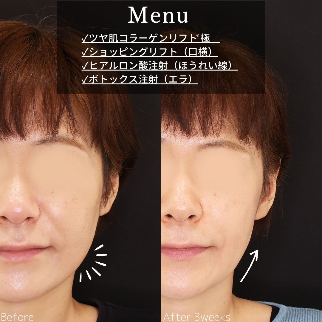 TAC式 ツヤ肌コラーゲンリフト®/ほうれい線のヒアルロン酸注射/エラボトックス注射の症例写真 施術前後 