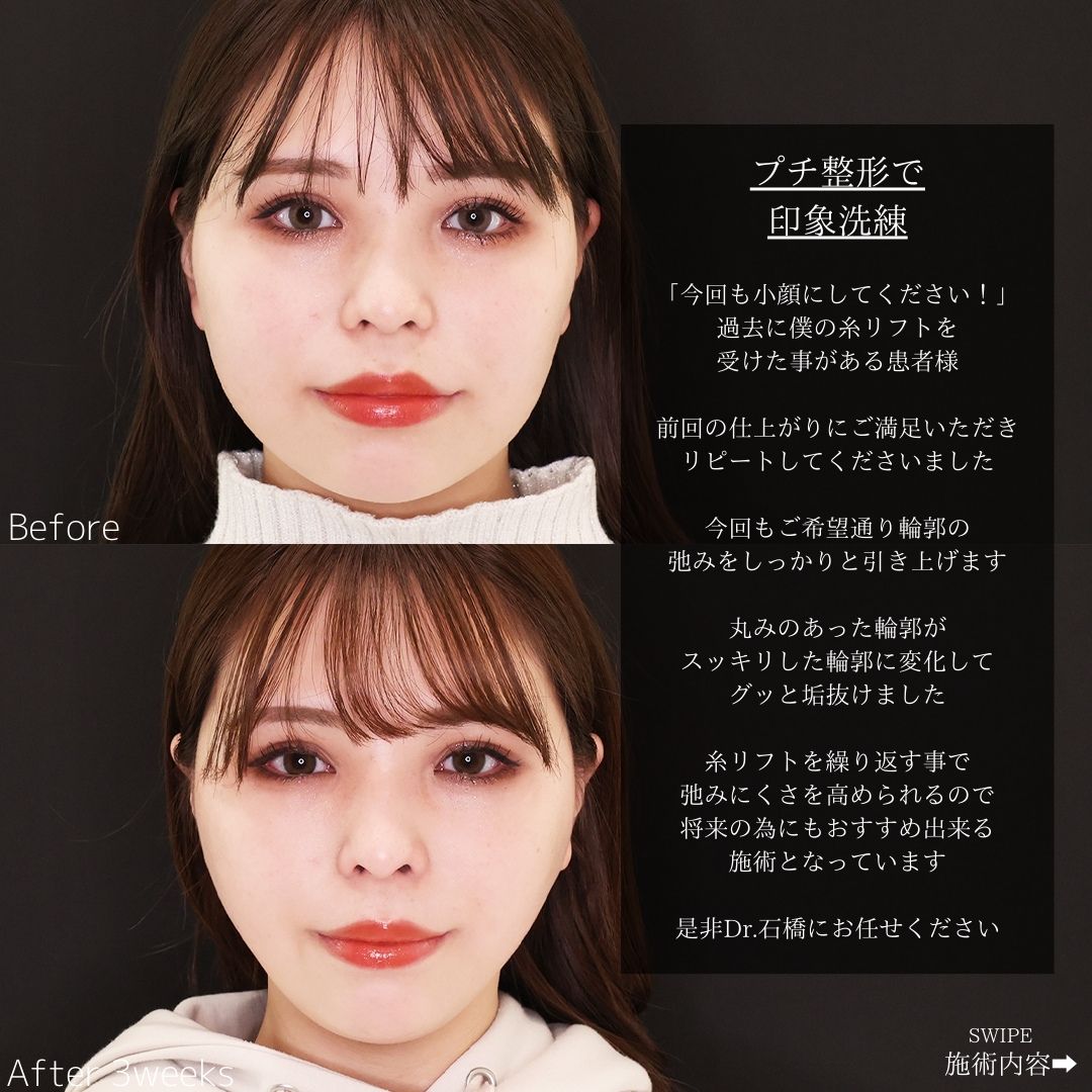 TAC式 ツヤ肌コラーゲンリフト®/エラボトックス注射の症例写真 施術前後 