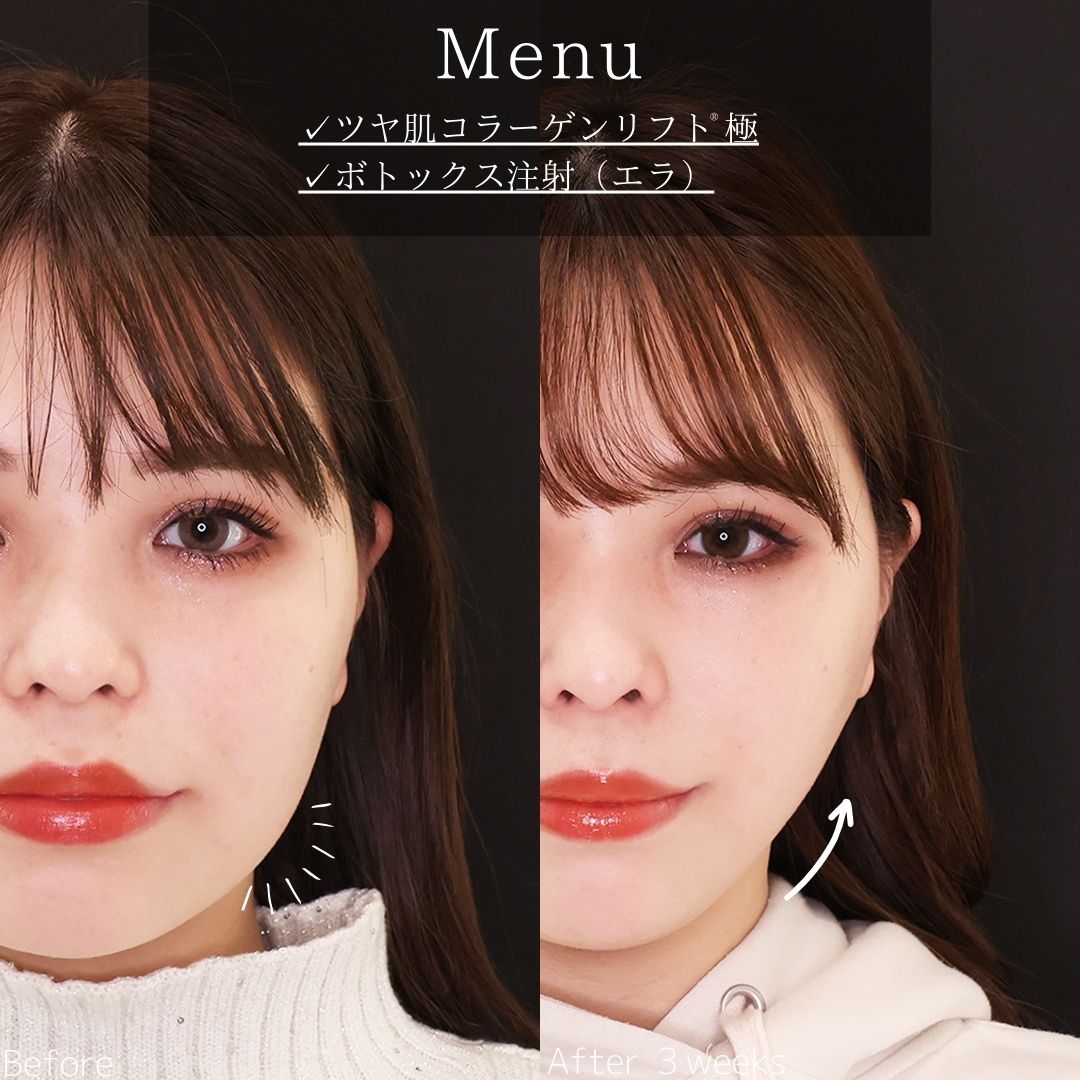 TAC式 ツヤ肌コラーゲンリフト®/エラボトックス注射の症例写真 施術前後 