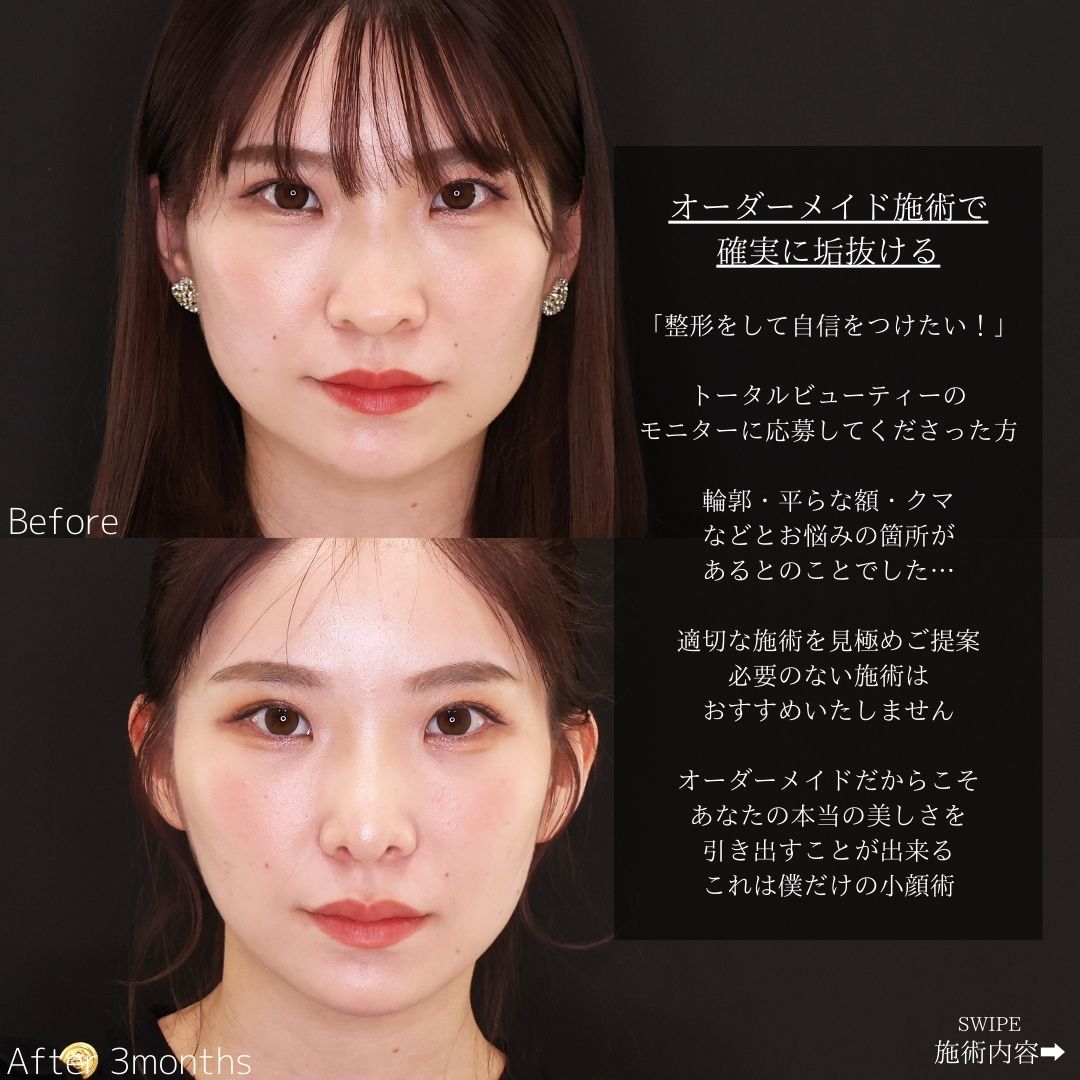 TAC式 ツヤ肌コラーゲンリフト®/エラボトックス注射/顔の脂肪注入(コンデンスリッチフェイス)の症例写真 施術前後 