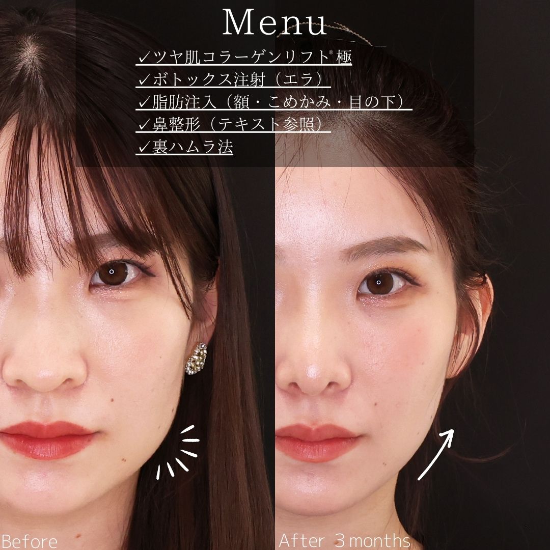 TAC式 ツヤ肌コラーゲンリフト®/エラボトックス注射/顔の脂肪注入(コンデンスリッチフェイス)の症例写真 施術前後 