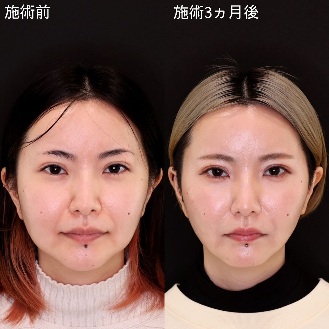 小顔術で確実な変化を！弛み改善リフト！