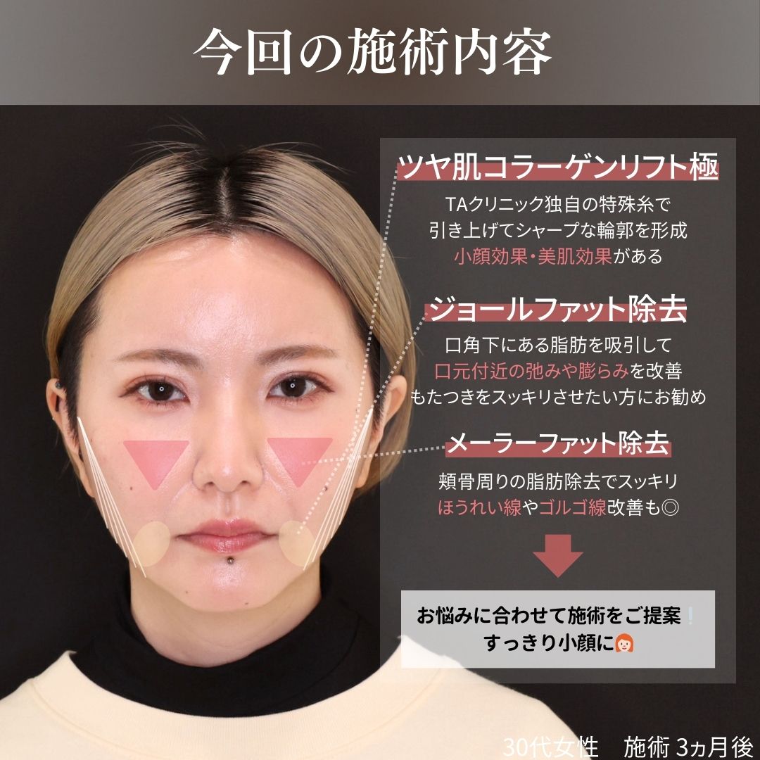 TAC式 ツヤ肌コラーゲンリフト®/ジョールファット除去/メーラーファット除去の症例写真 施術前後 