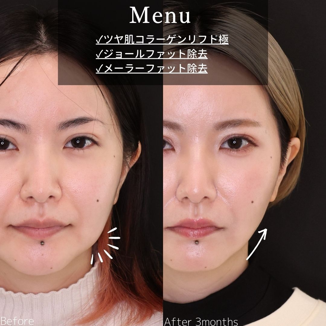 TAC式 ツヤ肌コラーゲンリフト®/ジョールファット除去/メーラーファット除去の症例写真 施術前後 