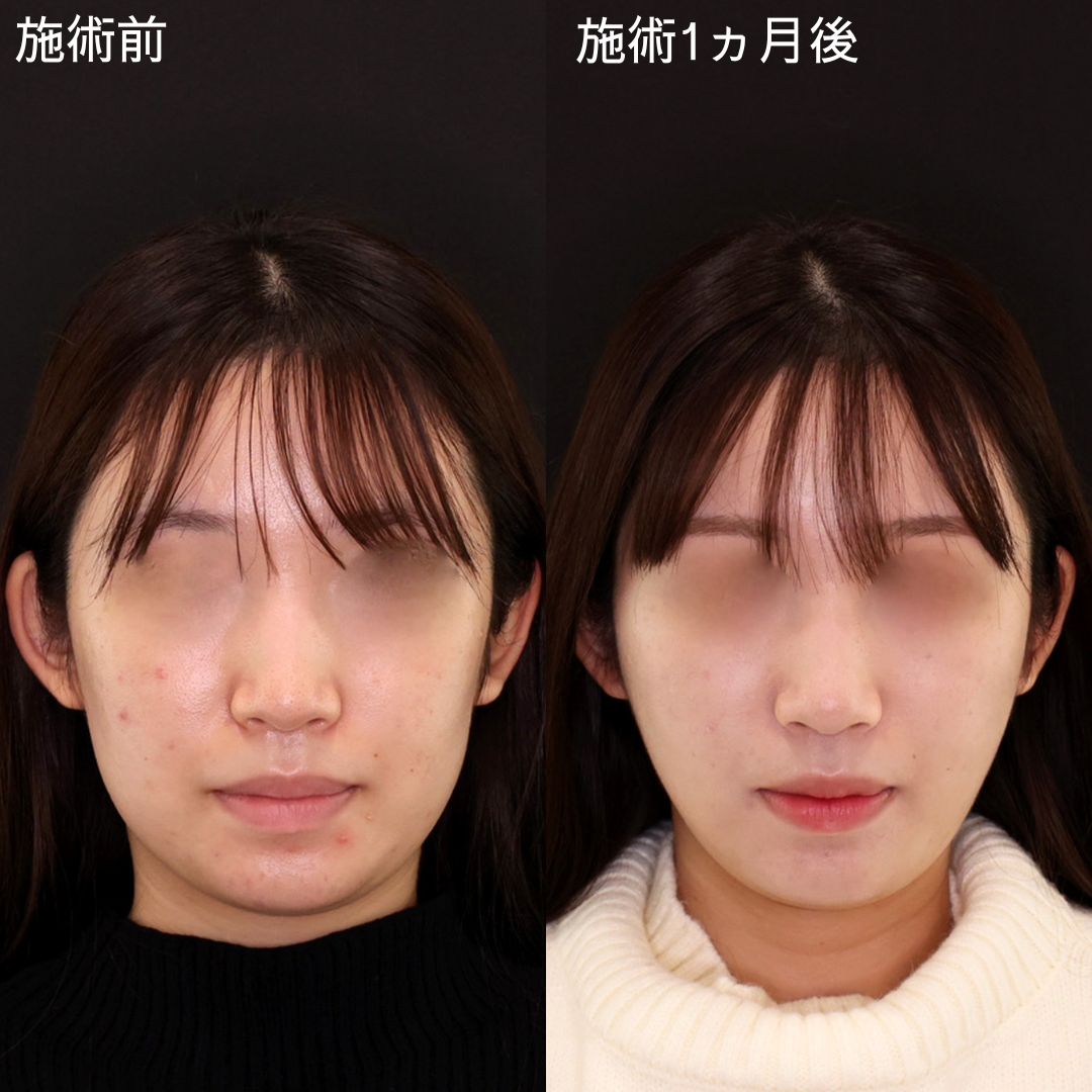 フェイスラインのもたつきを改善！Dr.石橋の垢抜け小顔術【小顔複合術】