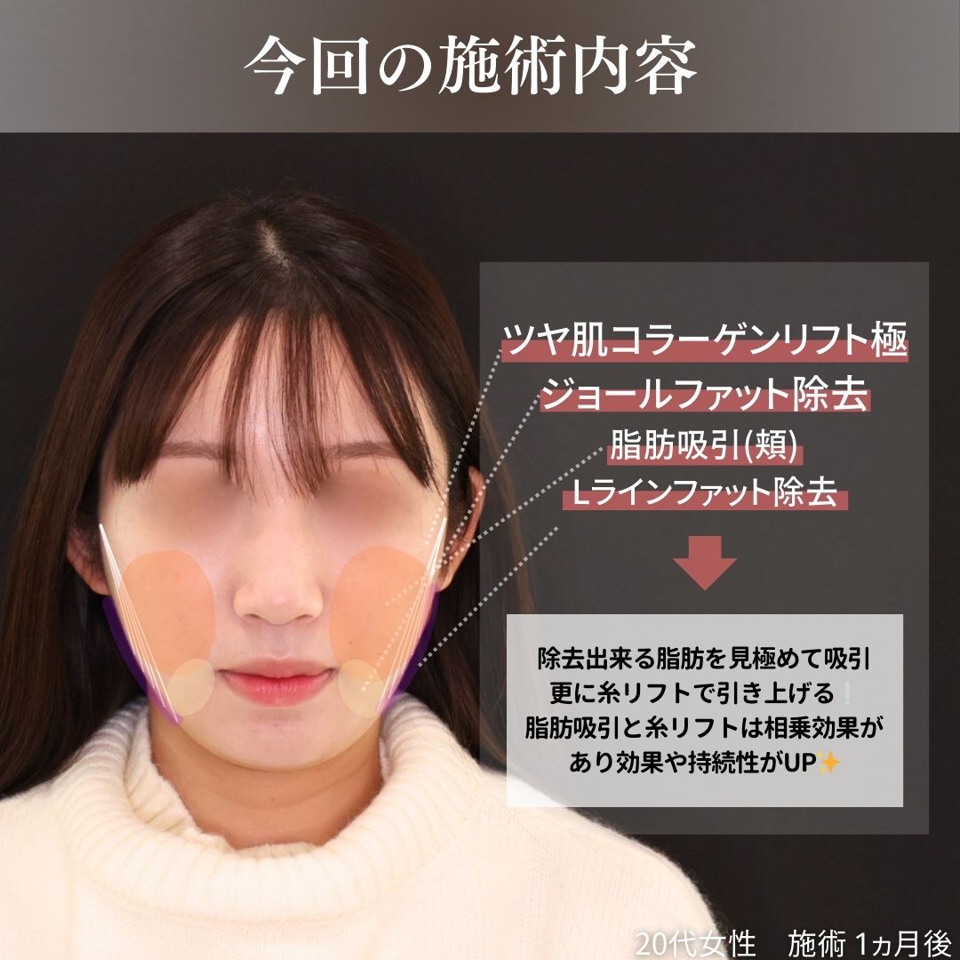 TAC式 ツヤ肌コラーゲンリフト®/ジョールファット除去/顔の脂肪吸引の症例写真 施術前後