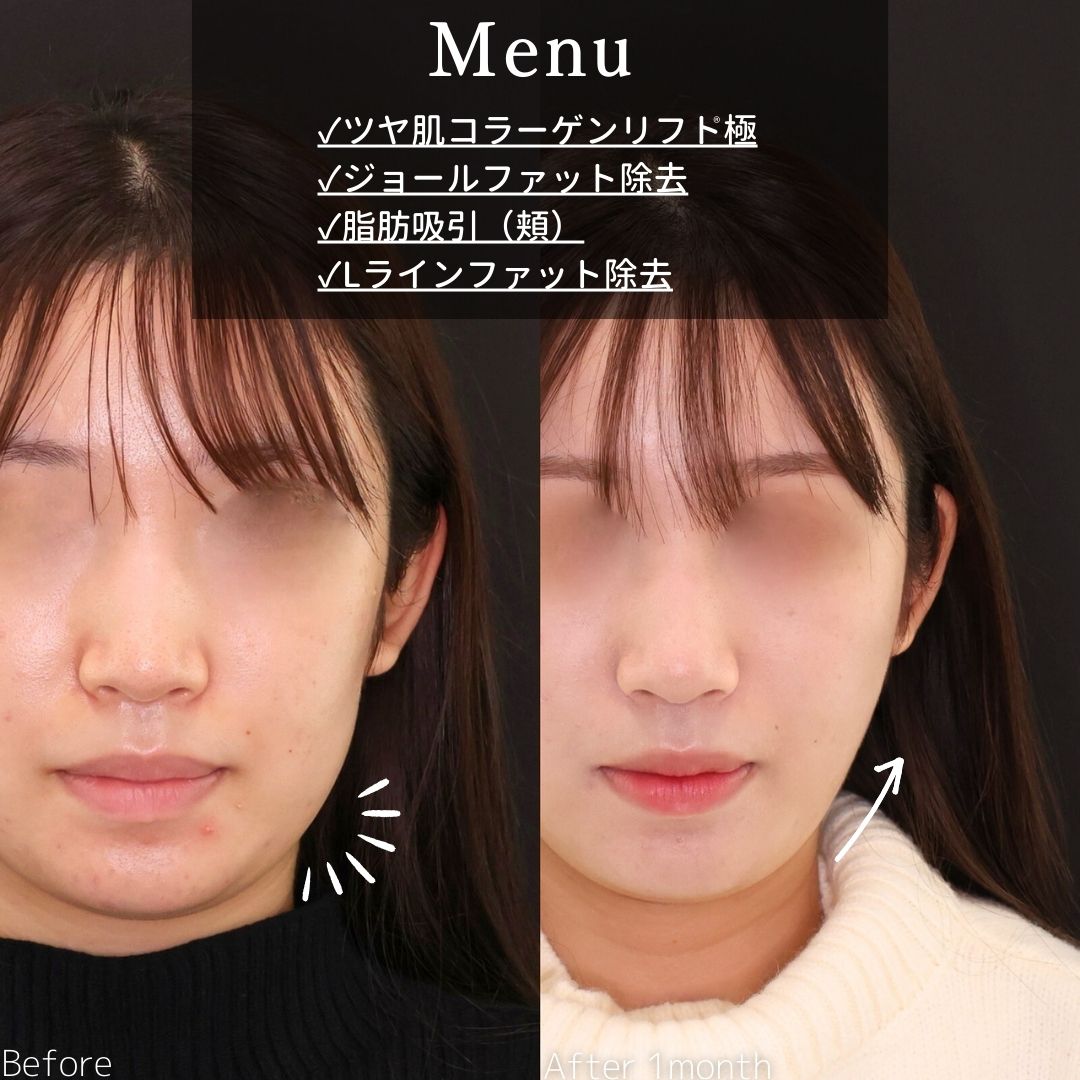 TAC式 ツヤ肌コラーゲンリフト®/ジョールファット除去/顔の脂肪吸引の症例写真 施術前後