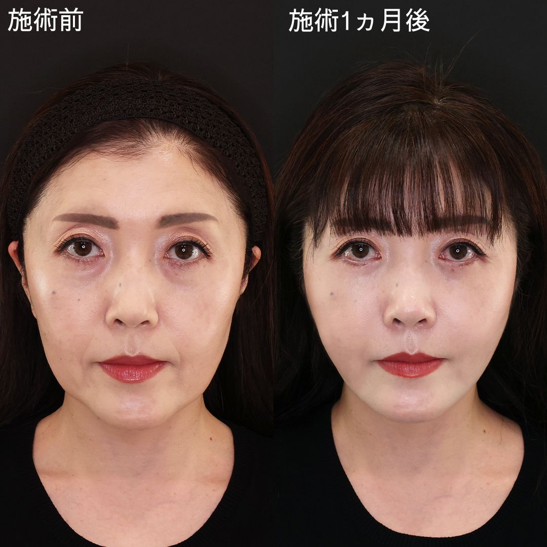 【糸リフト×脂肪吸引】人生を豊かにする若返り小顔術