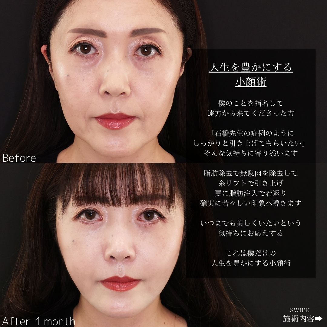 TAC式 ツヤ肌コラーゲンリフト®/ジョールファット除去/Lラインファット除去（エラ下脂肪除去）の症例写真 施術前後 