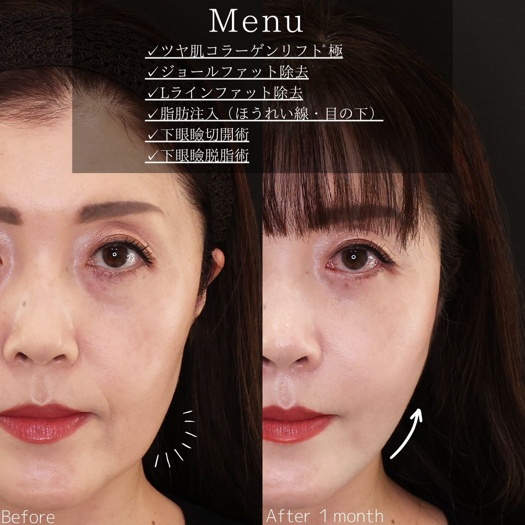 TAC式 ツヤ肌コラーゲンリフト®/ジョールファット除去/Lラインファット除去（エラ下脂肪除去）の症例写真 施術前後 