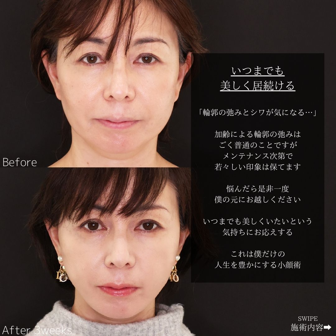 TAC式 ツヤ肌コラーゲンリフト®/ほうれい線のヒアルロン酸注射/目尻・目の下ボトックス注射の症例写真 施術前後 