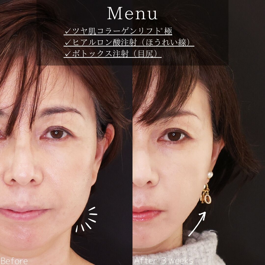 TAC式 ツヤ肌コラーゲンリフト®/ほうれい線のヒアルロン酸注射/目尻・目の下ボトックス注射の症例写真 施術前後 