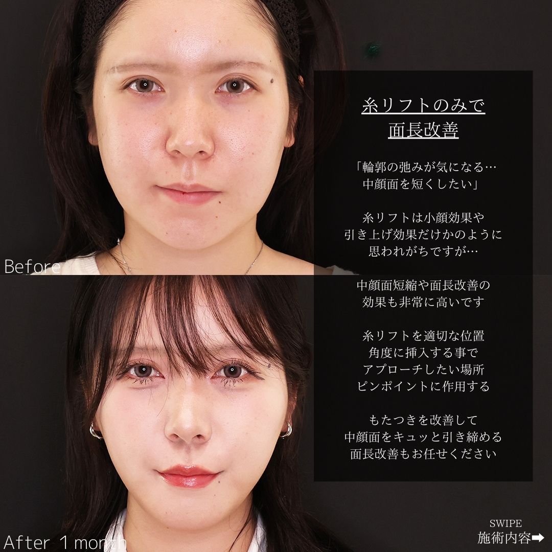 TAC式 ツヤ肌コラーゲンリフト®の症例写真 施術前後 