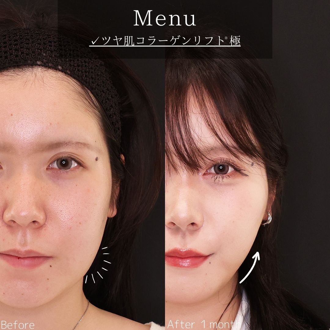 TAC式 ツヤ肌コラーゲンリフト®の症例写真 施術前後 