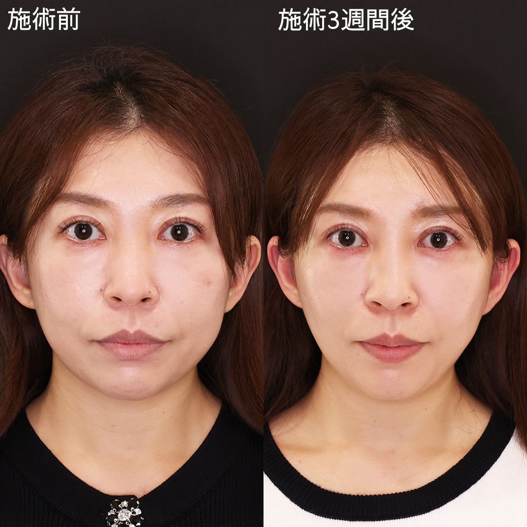 TAC式 ツヤ肌コラーゲンリフト®の症例写真 施術前後