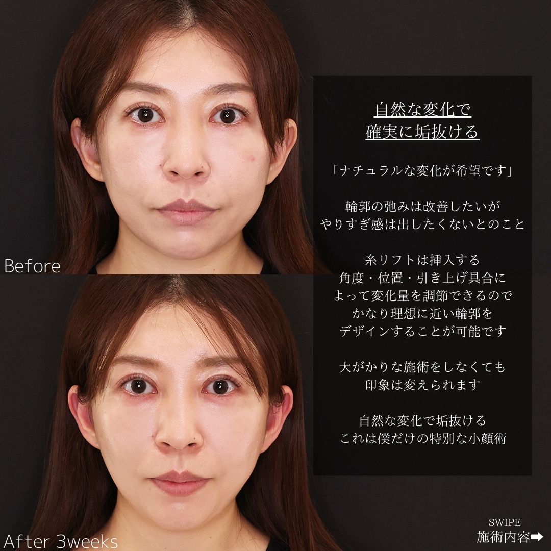 TAC式 ツヤ肌コラーゲンリフト®の症例写真 施術前後