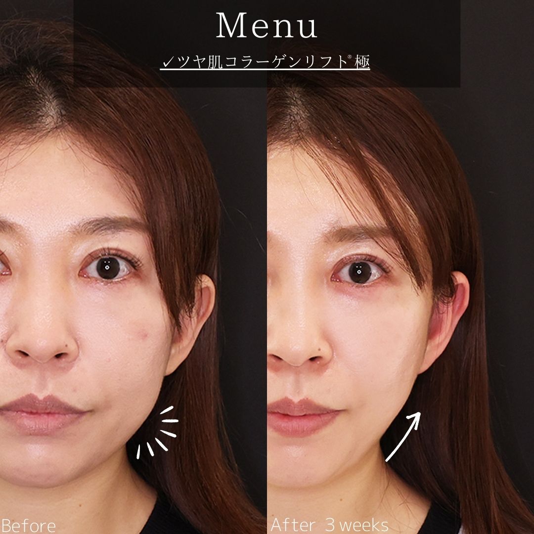 TAC式 ツヤ肌コラーゲンリフト®の症例写真 施術前後