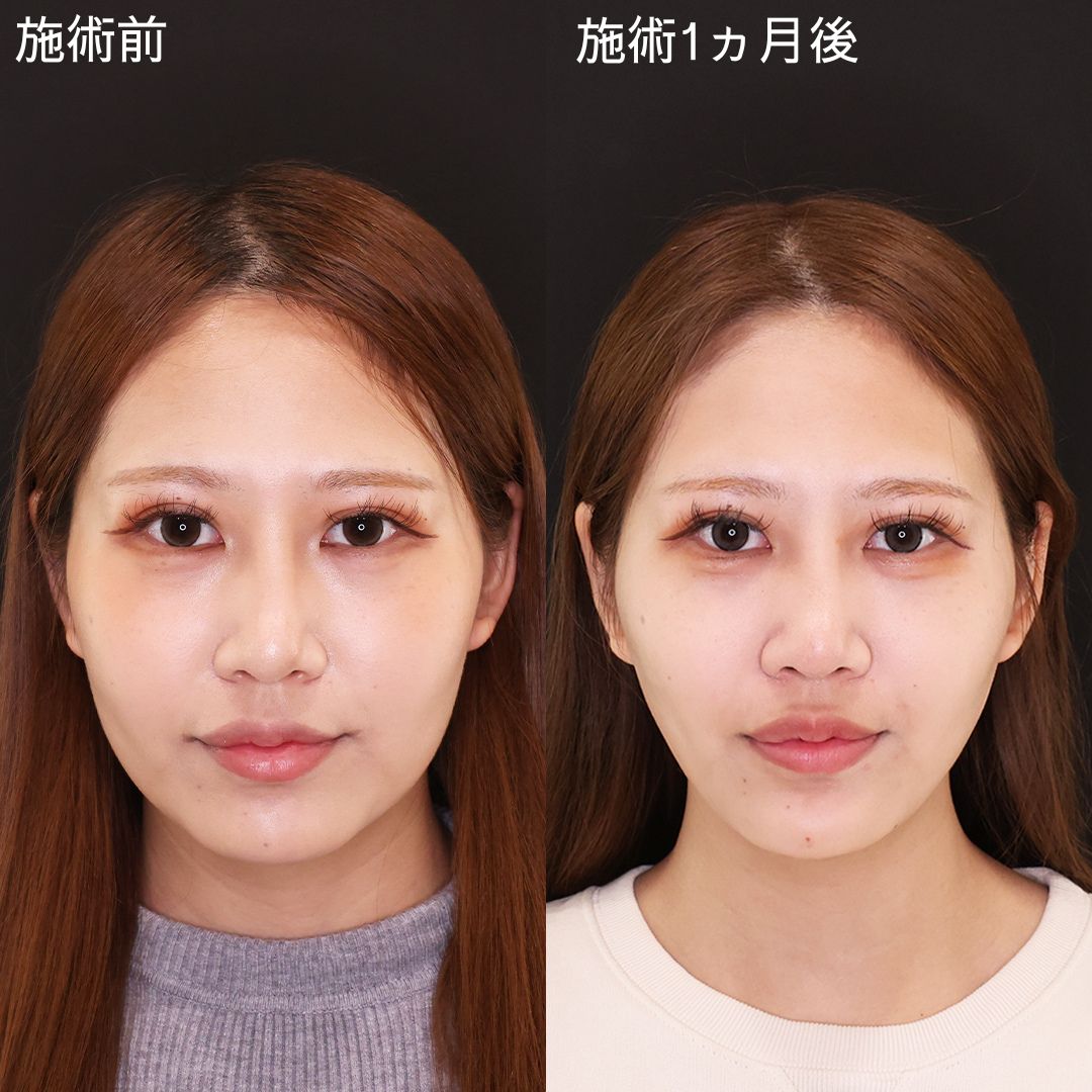 TAC式 ツヤ肌コラーゲンリフト®/Lラインファット除去(エラ下脂肪除去)の症例写真 施術前後