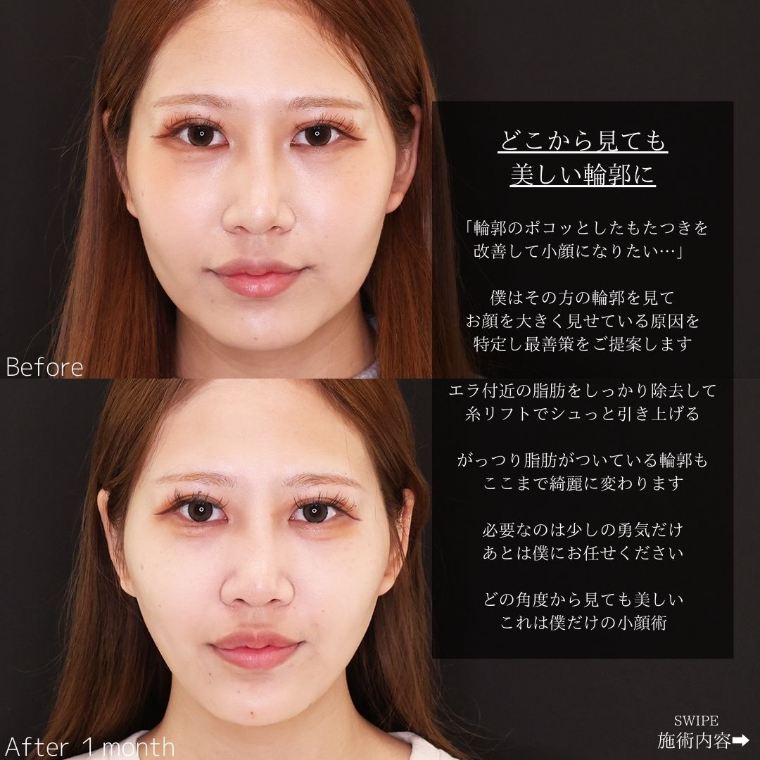 TAC式 ツヤ肌コラーゲンリフト®/Lラインファット除去(エラ下脂肪除去)の症例写真 施術前後