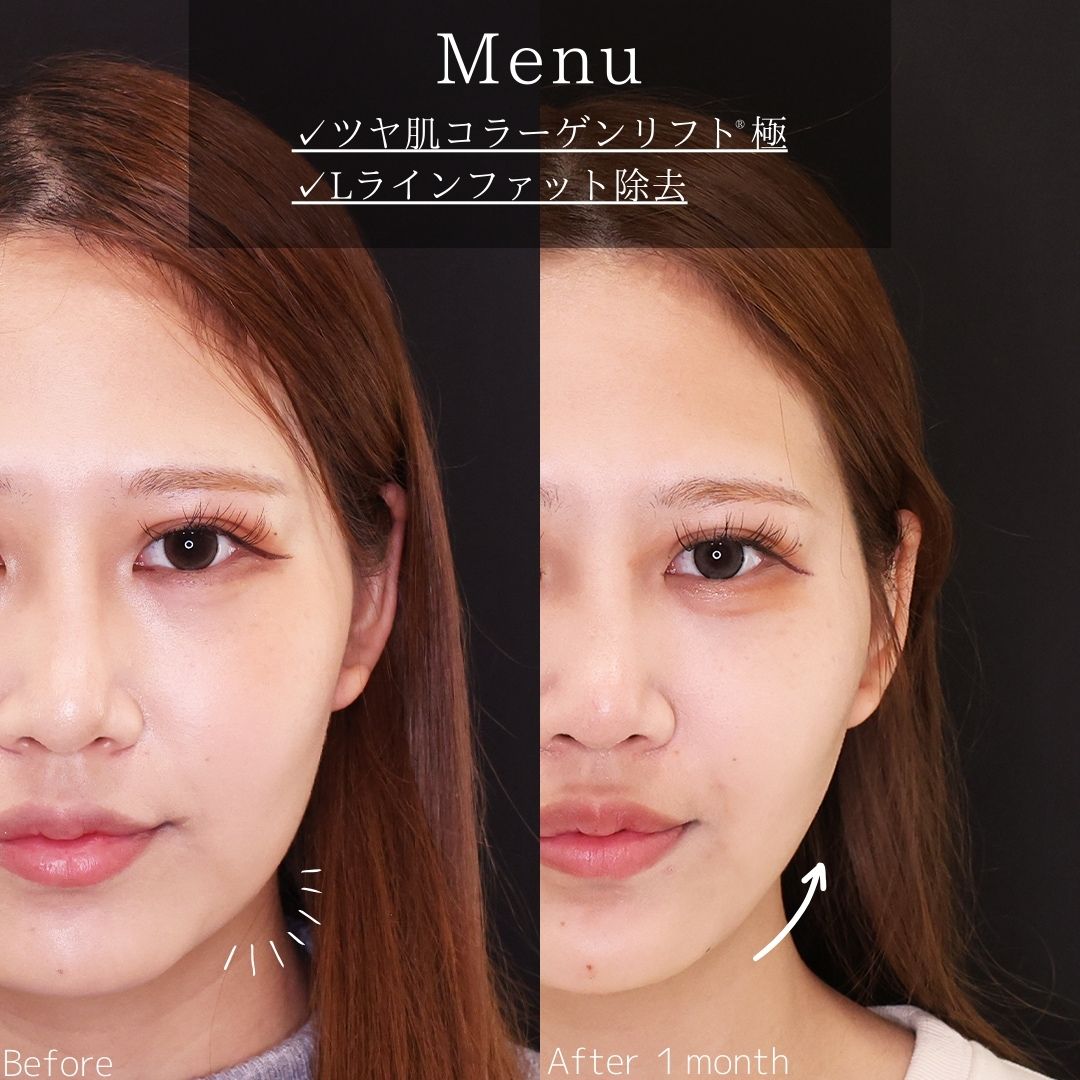 TAC式 ツヤ肌コラーゲンリフト®/Lラインファット除去(エラ下脂肪除去)の症例写真 施術前後