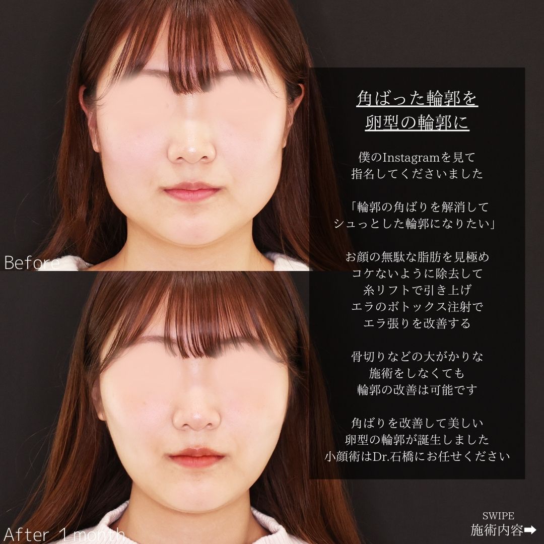 TAC式 ツヤ肌コラーゲンリフト®/バッカルファット除去/顔の脂肪吸引の症例写真 施術前後 