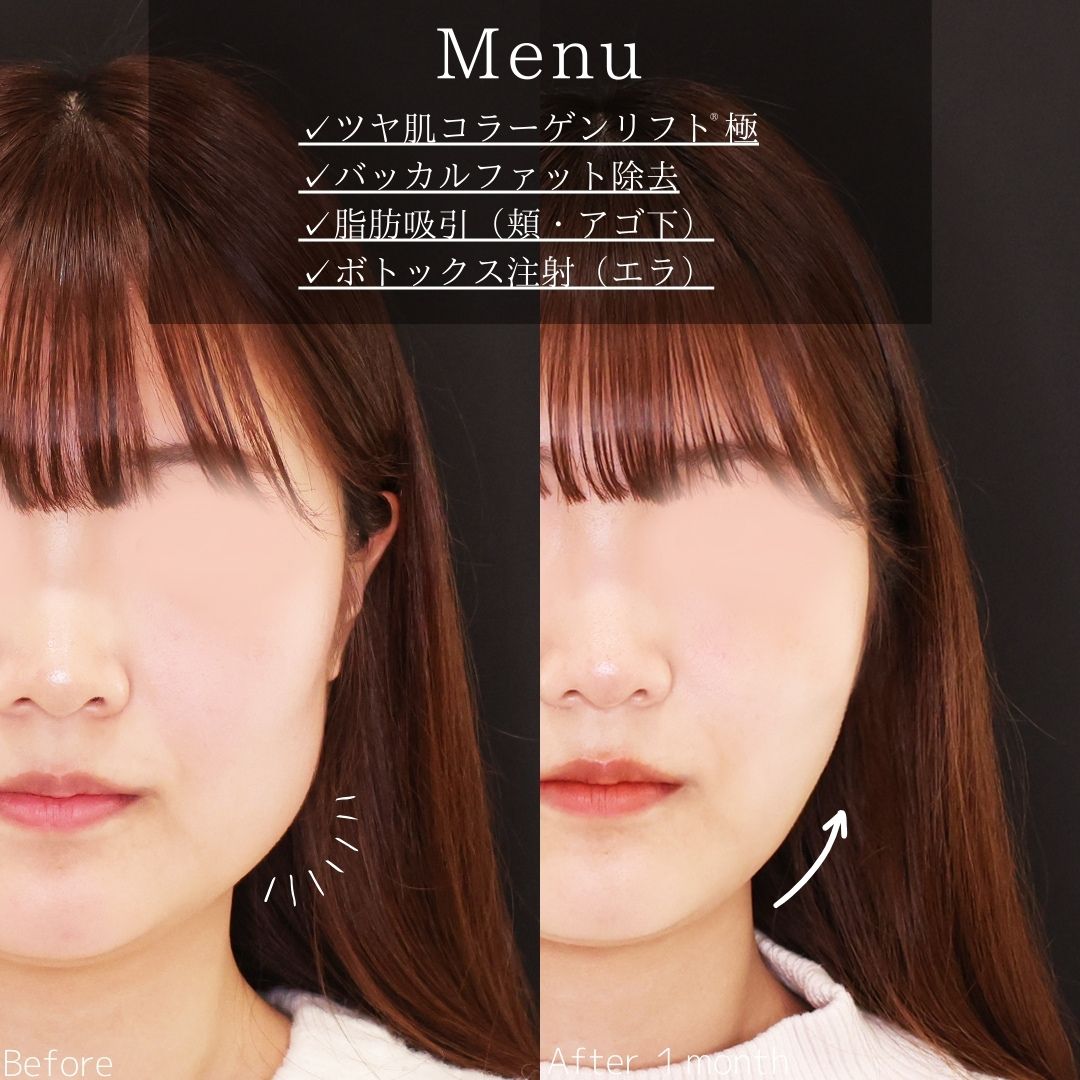 TAC式 ツヤ肌コラーゲンリフト®/バッカルファット除去/顔の脂肪吸引の症例写真 施術前後 