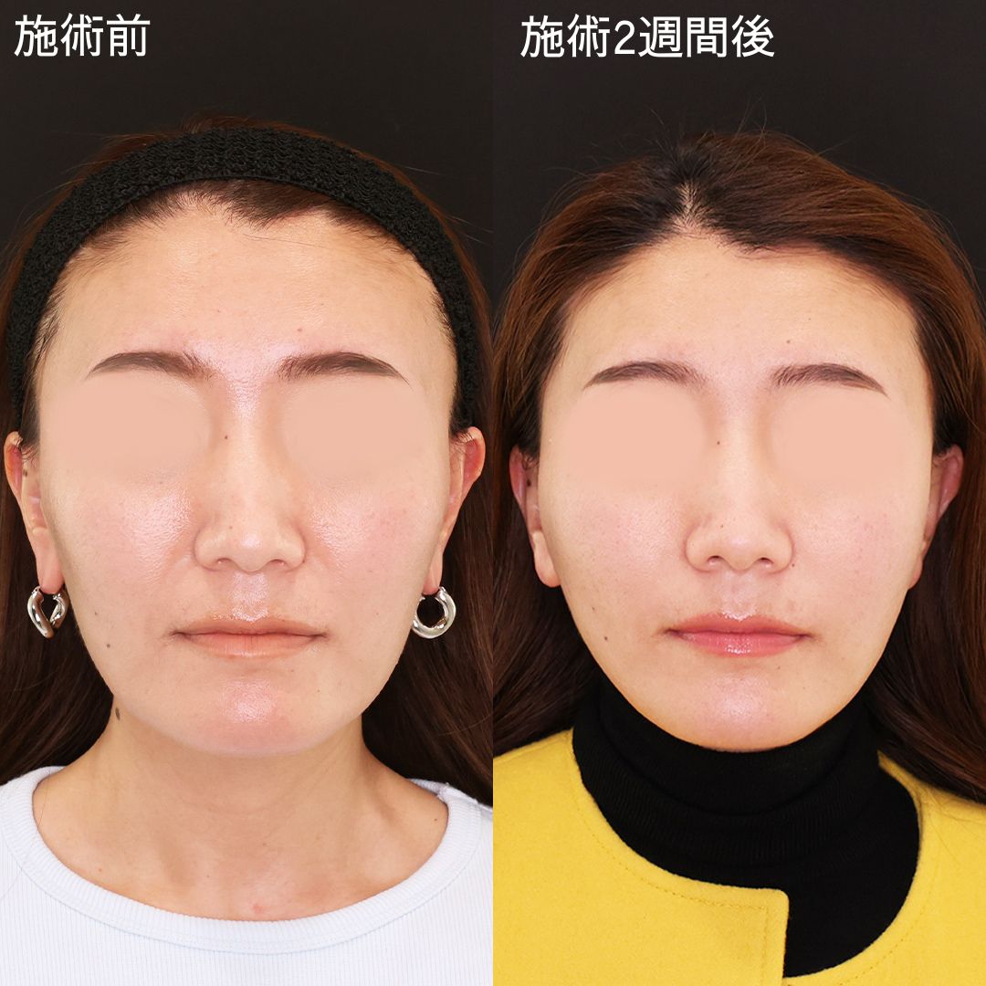 ナチュラルに輪郭を整える！バレない小顔術【糸リフト】