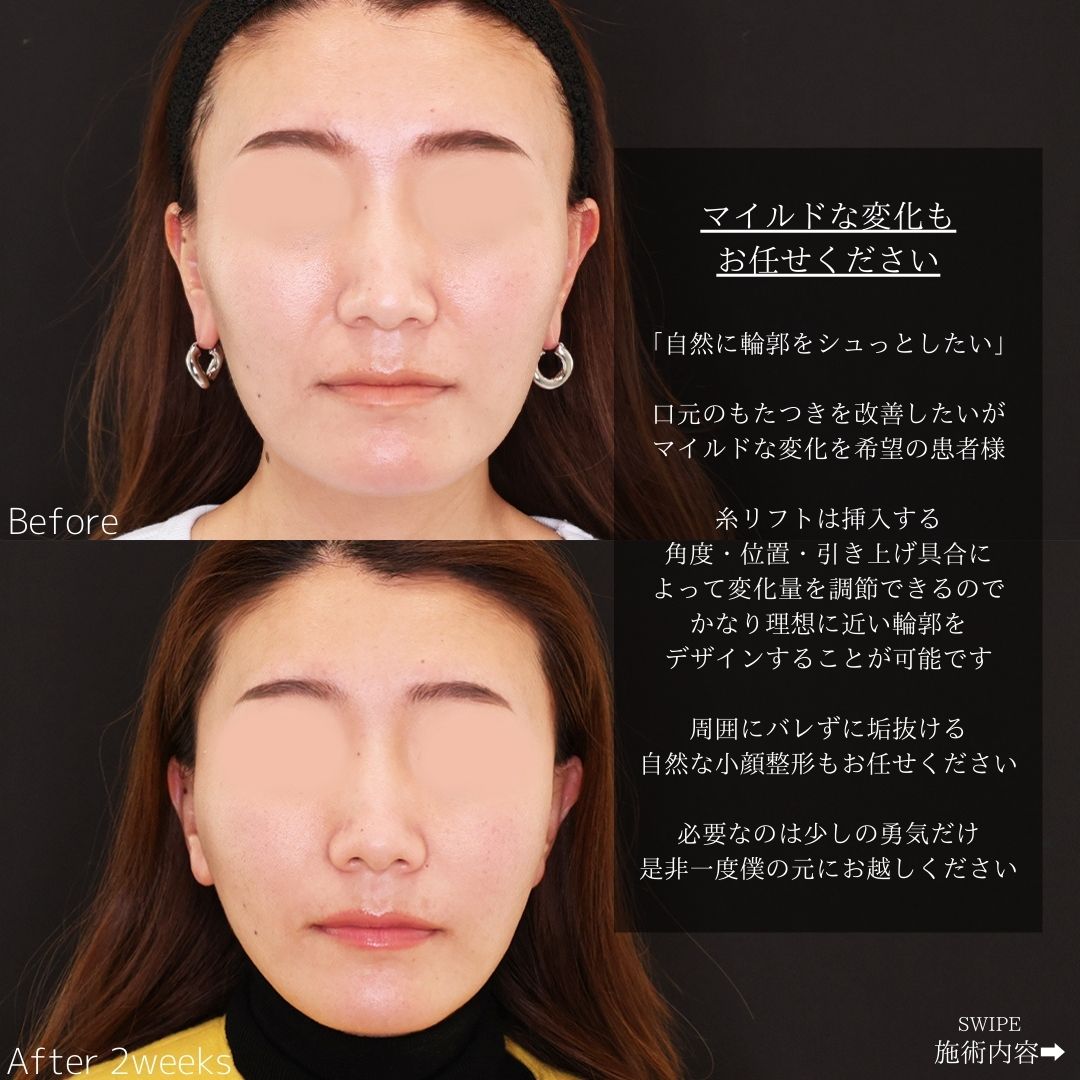 TAC式 ツヤ肌コラーゲンリフト®/ほうれい線のヒアルロン酸注射の症例写真 施術前後 