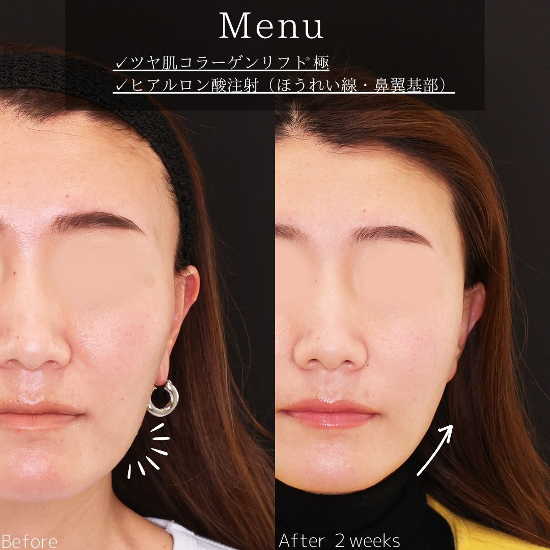 TAC式 ツヤ肌コラーゲンリフト®/ほうれい線のヒアルロン酸注射の症例写真 施術前後 