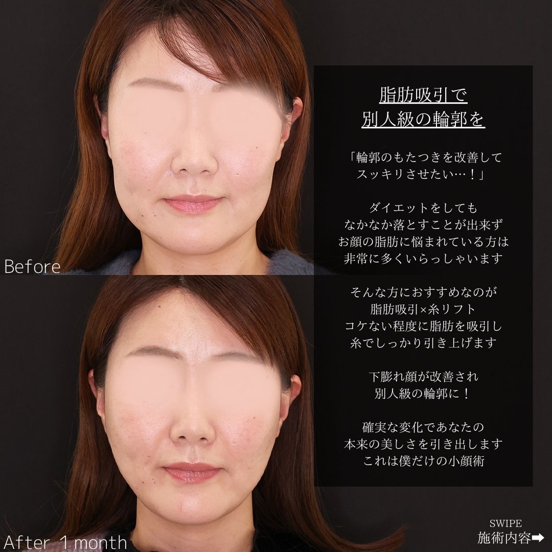 TAC式 ツヤ肌コラーゲンリフト®/メーラーファット除去/ジョールファット除去の症例写真 施術前後 