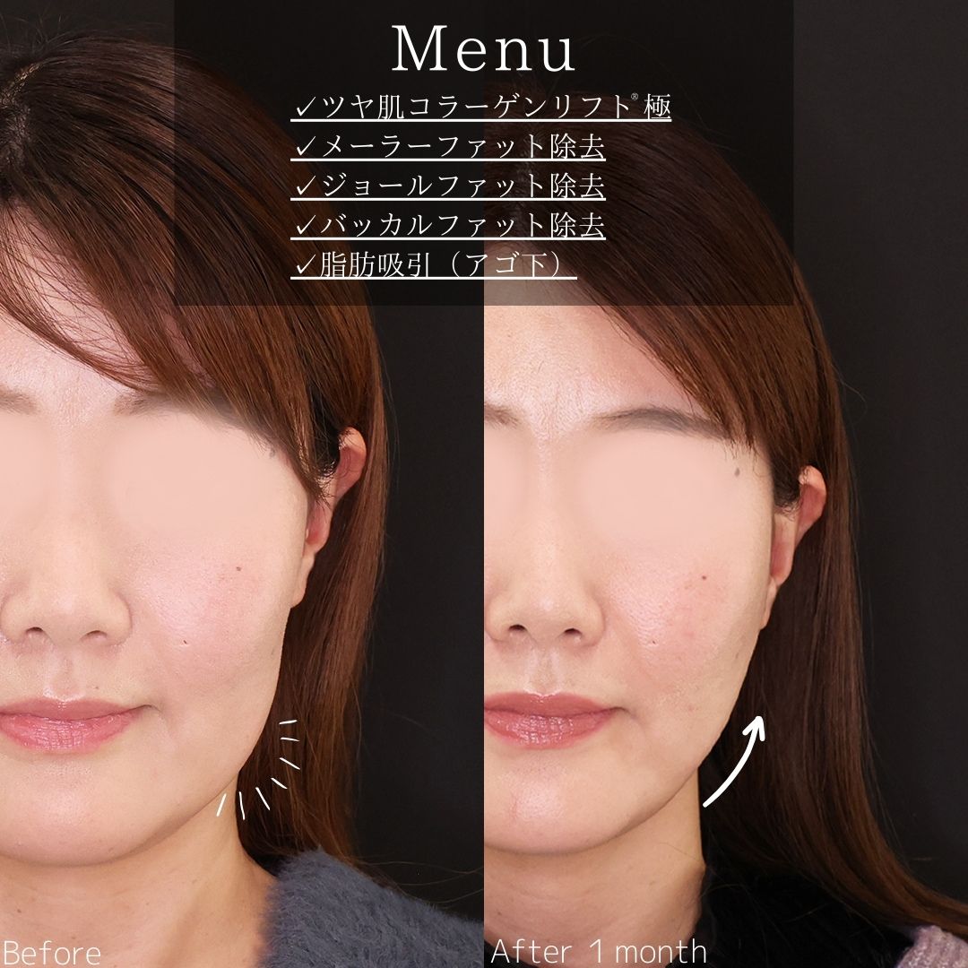 TAC式 ツヤ肌コラーゲンリフト®/メーラーファット除去/ジョールファット除去の症例写真 施術前後 
