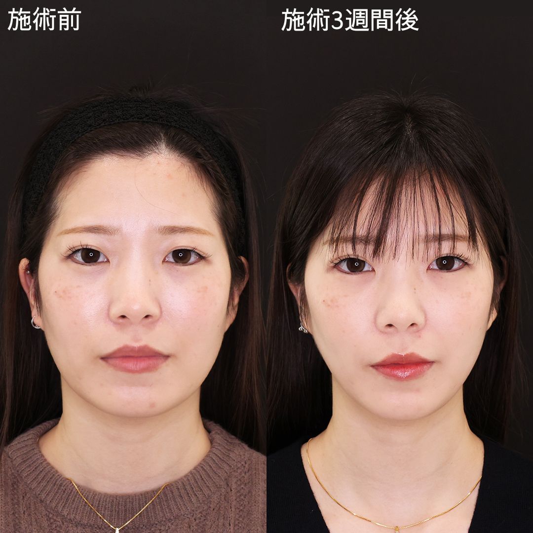 【糸リフト】本来の輪郭を引き出す垢抜け小顔術