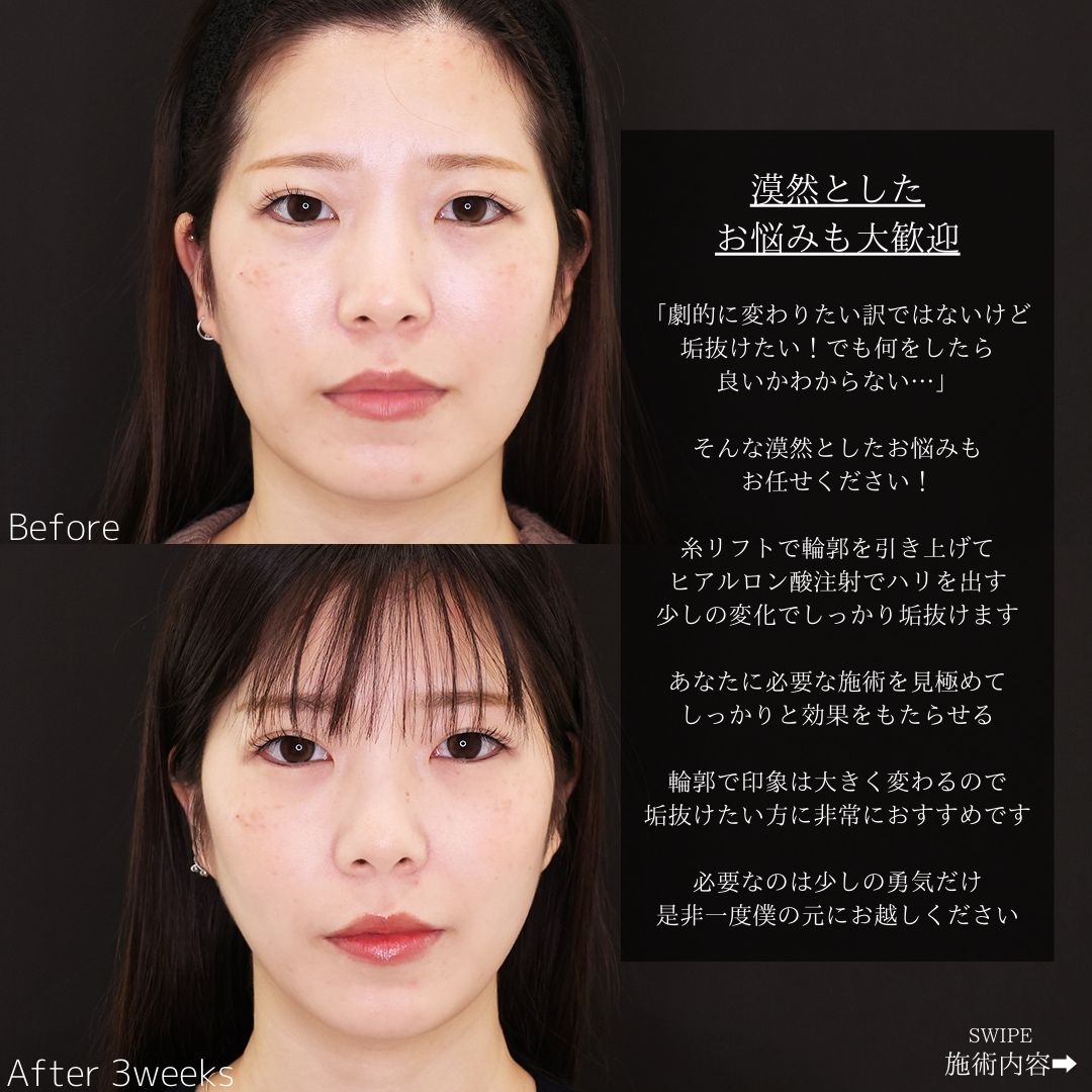 TAC式 ツヤ肌コラーゲンリフト®/ほうれい線のヒアルロン酸注射の症例写真 施術前後 