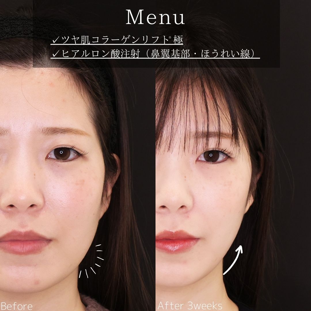 TAC式 ツヤ肌コラーゲンリフト®/ほうれい線のヒアルロン酸注射の症例写真 施術前後 