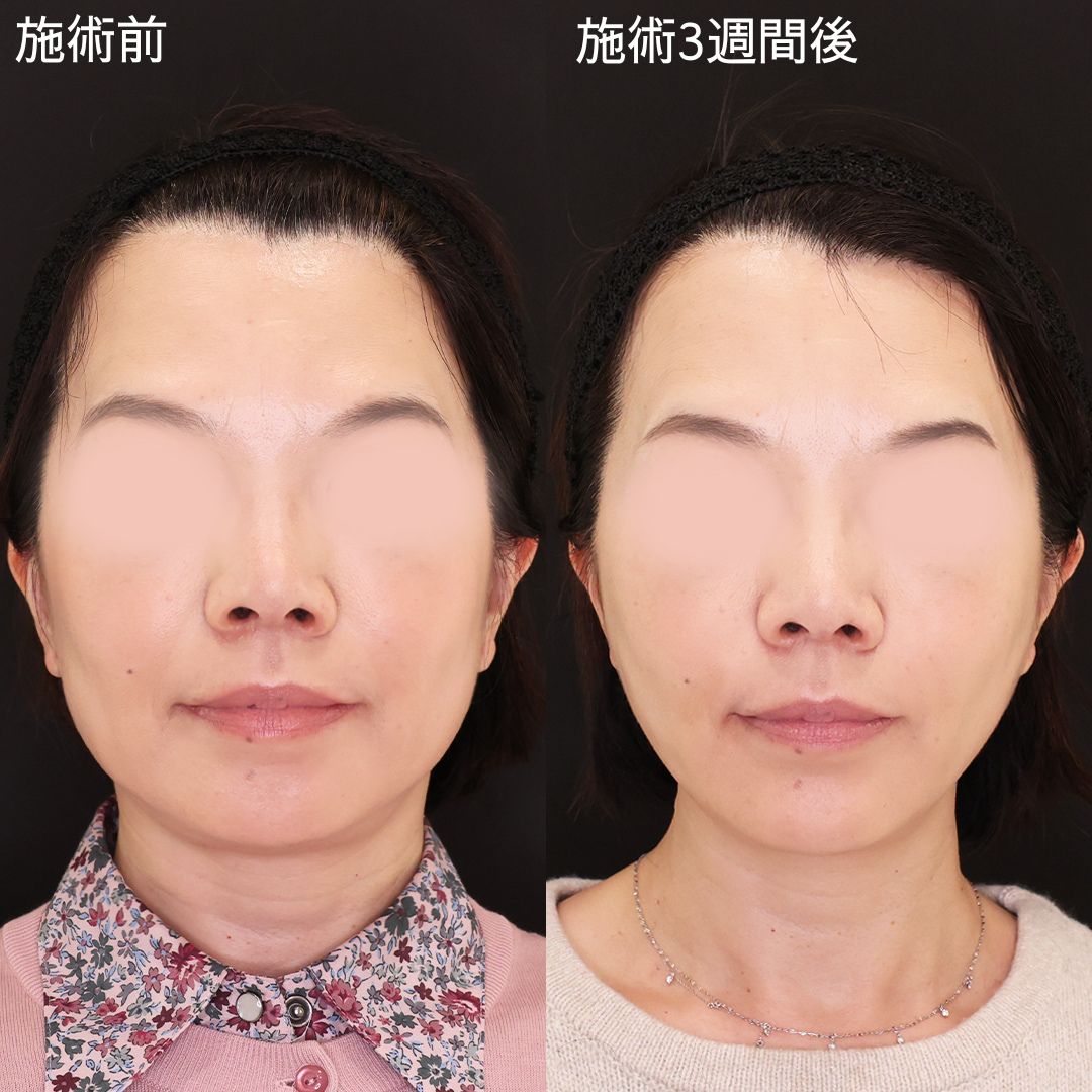 輪郭のみでこの変化！若返り小顔術【糸リフト】
