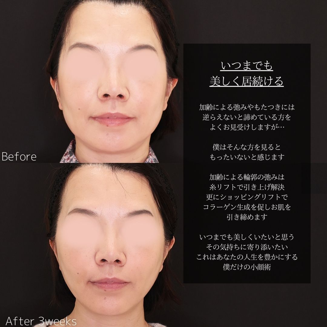 TAC式 ツヤ肌コラーゲンリフト®/TAC式 ショッピングリフト/顎のヒアルロン酸注射の症例写真 施術前後 