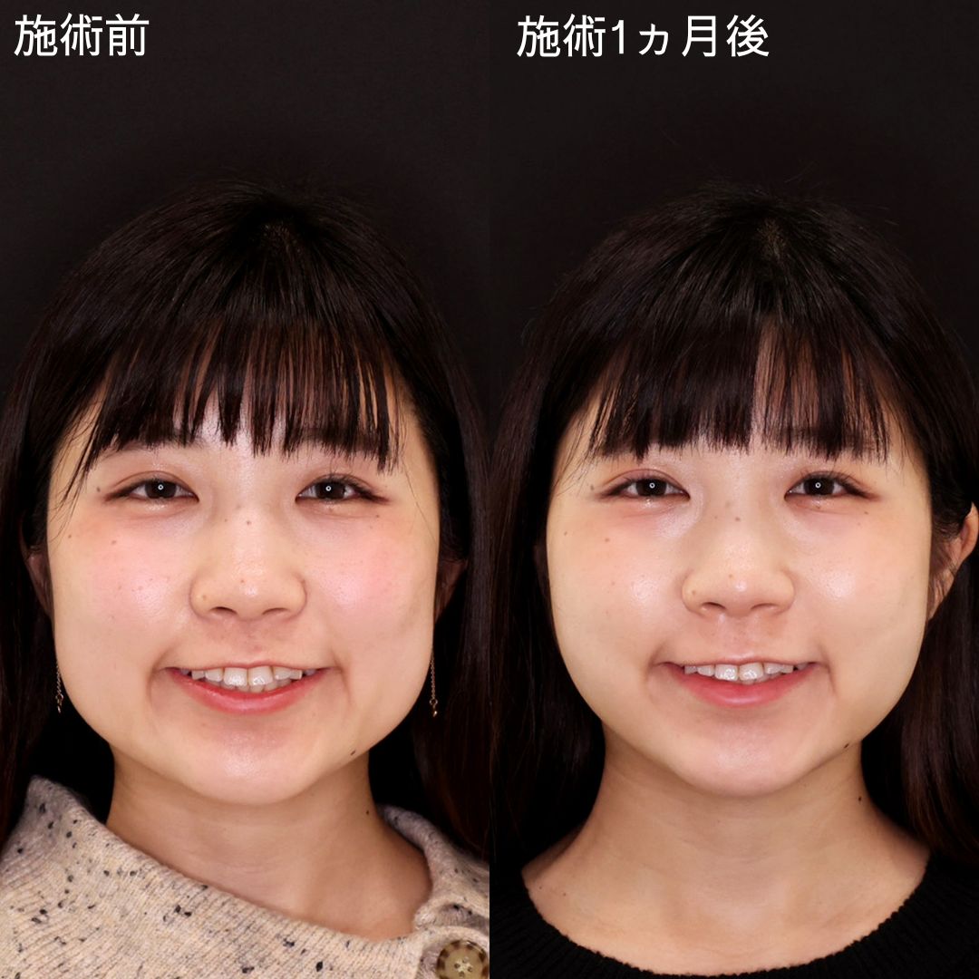 TAC式 ツヤ肌コラーゲンリフト®/バッカルファット除去/ジョールファット除去の症例写真 施術前後