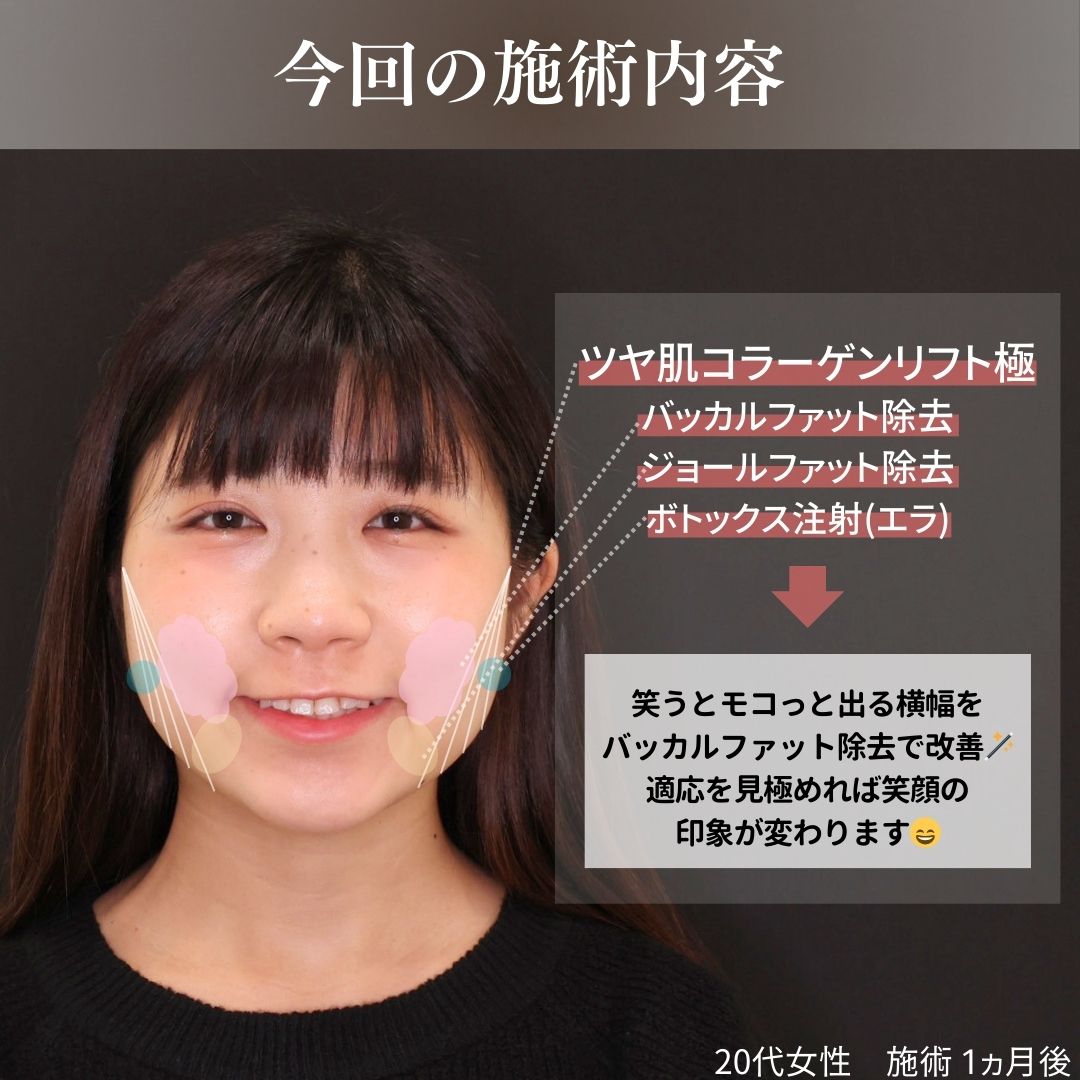 TAC式 ツヤ肌コラーゲンリフト®/バッカルファット除去/ジョールファット除去の症例写真 施術前後