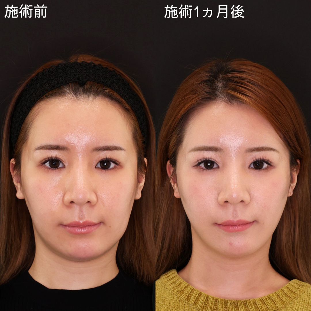 TAC式 ツヤ肌コラーゲンリフト®の症例写真 施術前後 